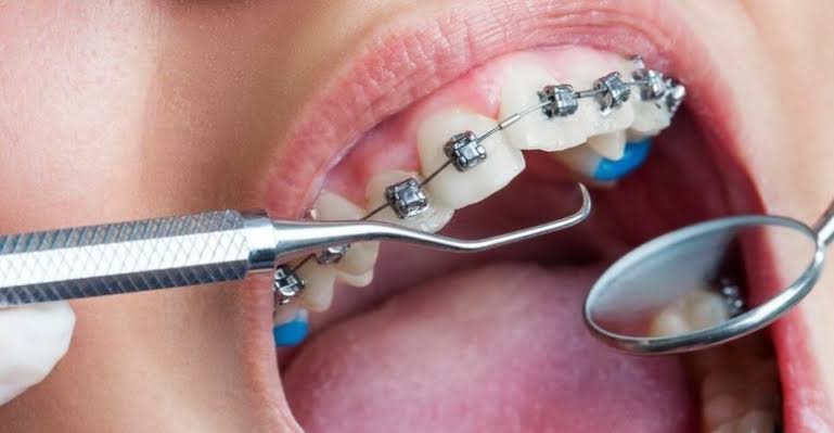 علاج العصب والحشوات التجميلية